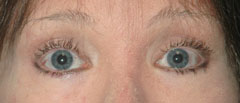 Revision Blepharoplasty - Patient 3 - After